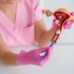 Doctor pointing at a uterus and ovaries anatomy model, illustrating the impacts of endometriosis on female reproductive organs.